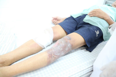 Cách xử lý và phòng ngừa chấn thương gối khi đá bóng 3 chan-thuong-dau-goi-khi-da-bong-2