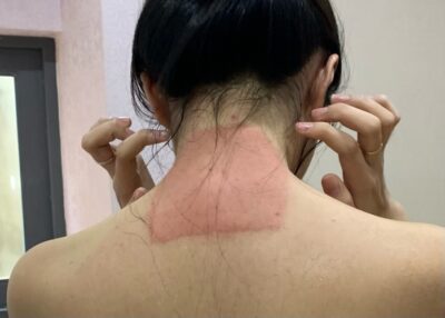 TAC-DUNG-PHU-CUA-MIENG-GIAM-DAU-1