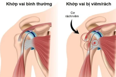chan-thuong-vai-khi-tap-gym2