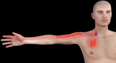 dau-ba-vai-trai-phai-lan-xuong-canh-tay-3