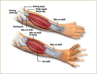 Cách giảm mỏi cơ tay hiệu quả và an toàn 2 moi-co-tay-3